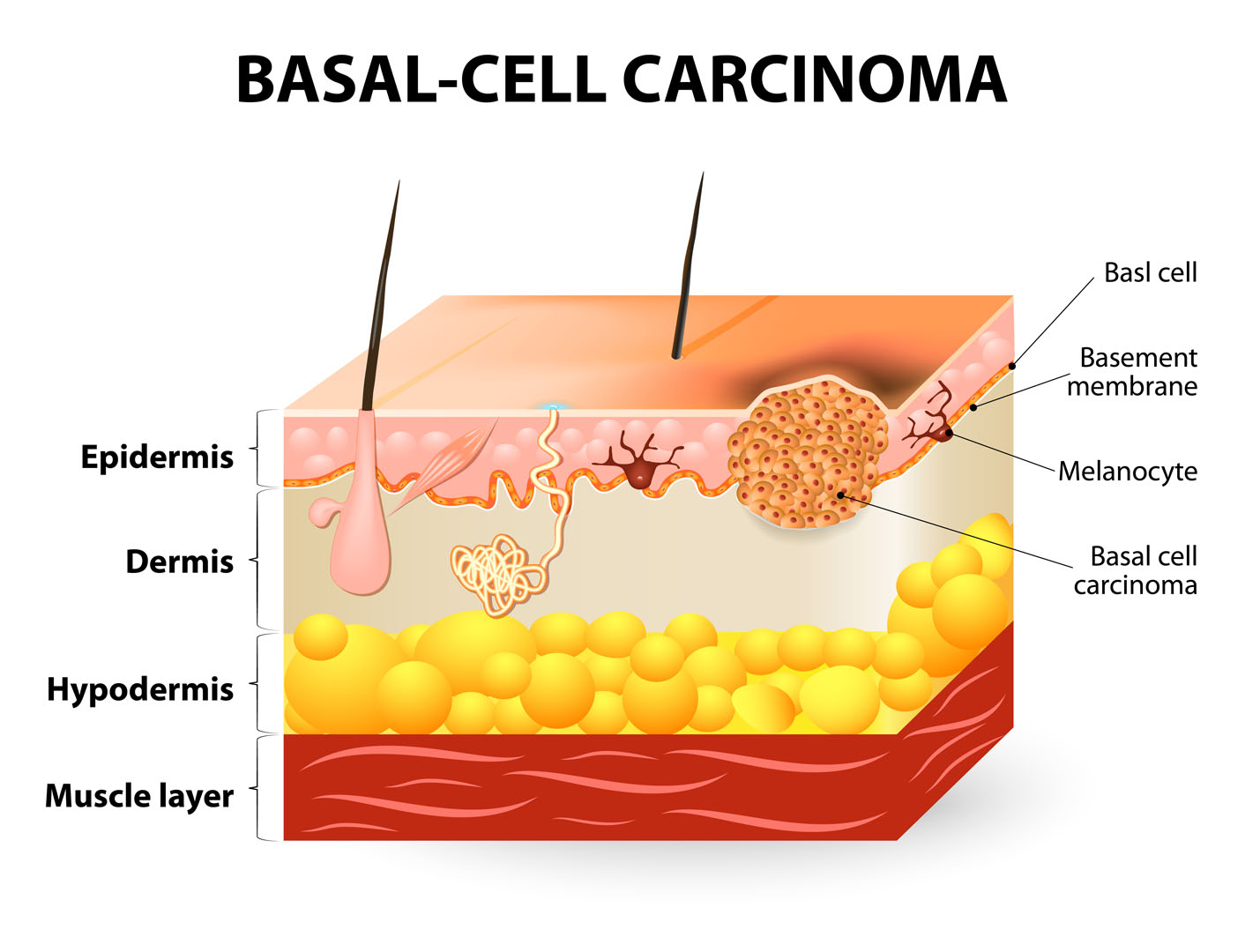 Basal Cell Carcinoma (BCC) - CBD Skin Cancer Clinic